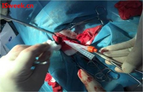 一種用于膀胱內壓監測的光纖壓力傳感器FOP-M260