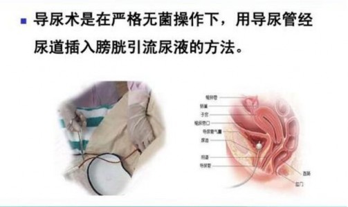 光纖壓力傳感器應用于導尿管膀胱內壓力監控