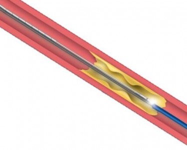 光纖壓力傳感器在血流儲備分數（FFR）系統中的應用