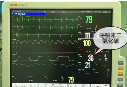 CO2傳感器在呼氣末二氧化碳(ETCO2)監測中的應用