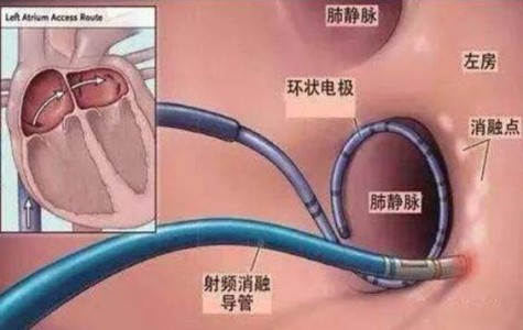 射頻消融手術過程溫度監控中應用的光纖溫度傳感器