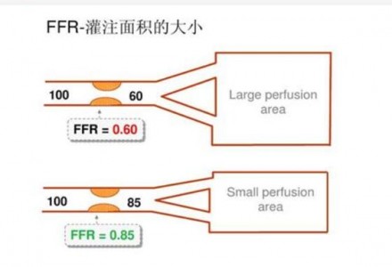 應用在血流儲備分數FFR系統中檢測壓力的光纖壓力傳感器