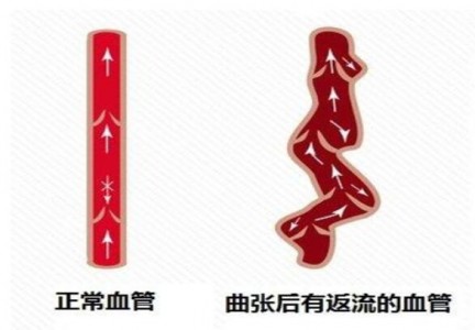 應用在無創測量靜脈曲張壓力中的光纖壓力傳感器