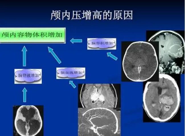 用于顱內壓監測的光纖壓力傳感器